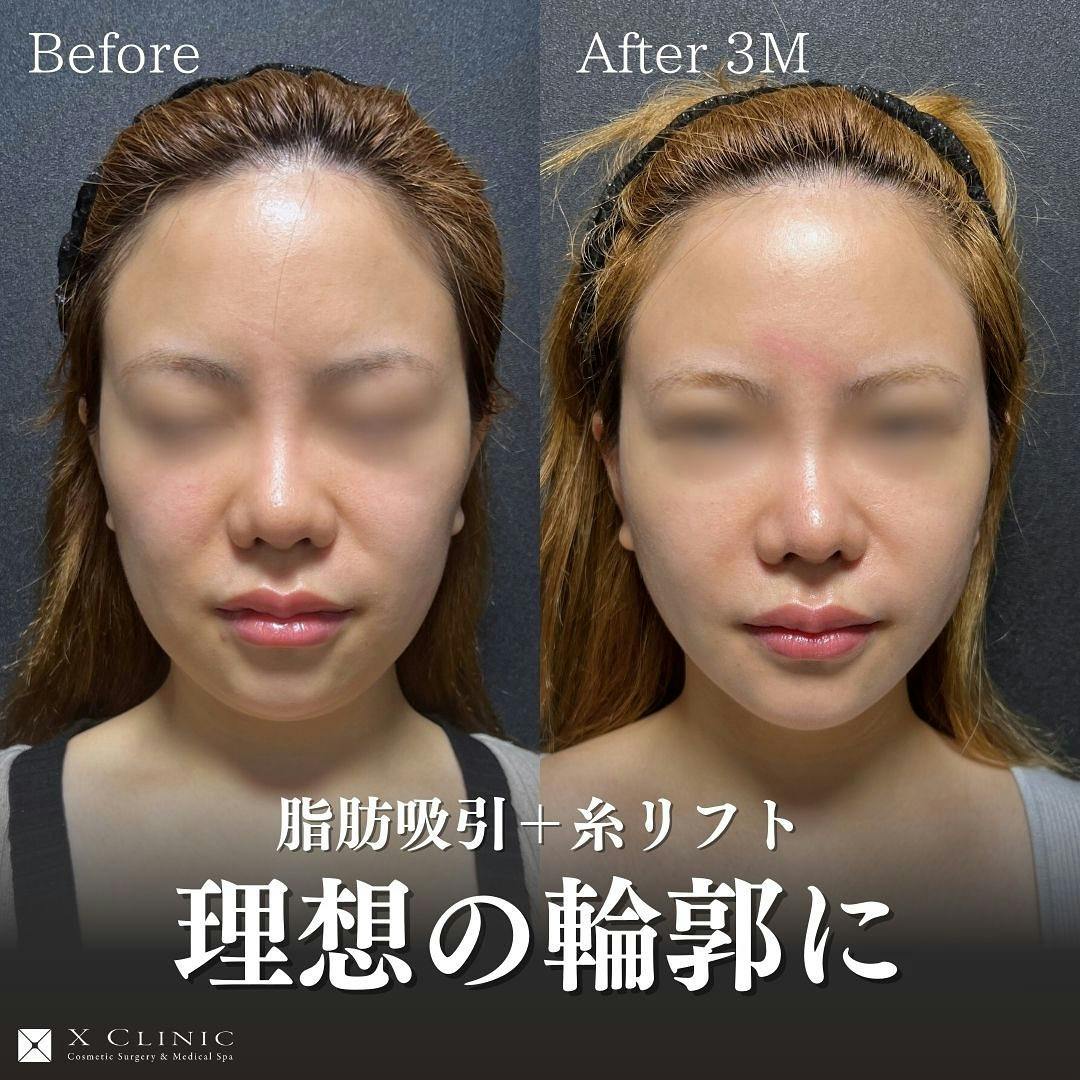 【30代女性・たるみ】脂肪吸引＋糸リフト_before_aftar