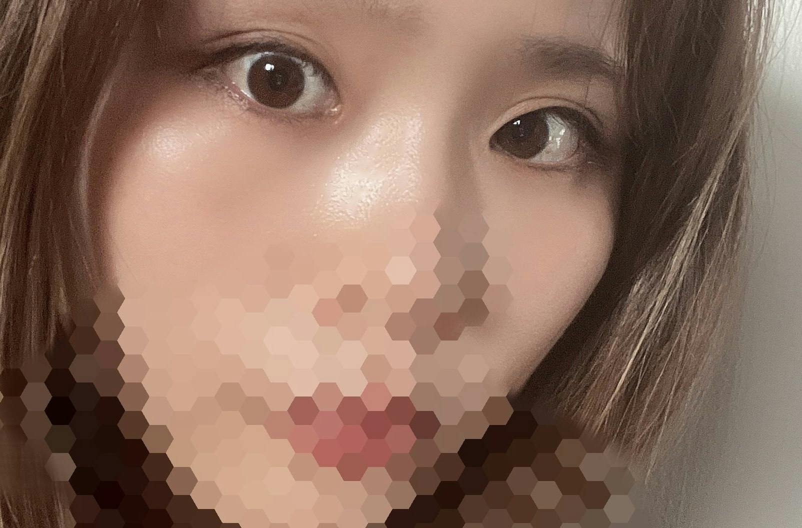 東京美容外科 福岡院でほくろ・いぼ除去を受けたりりさんの写真