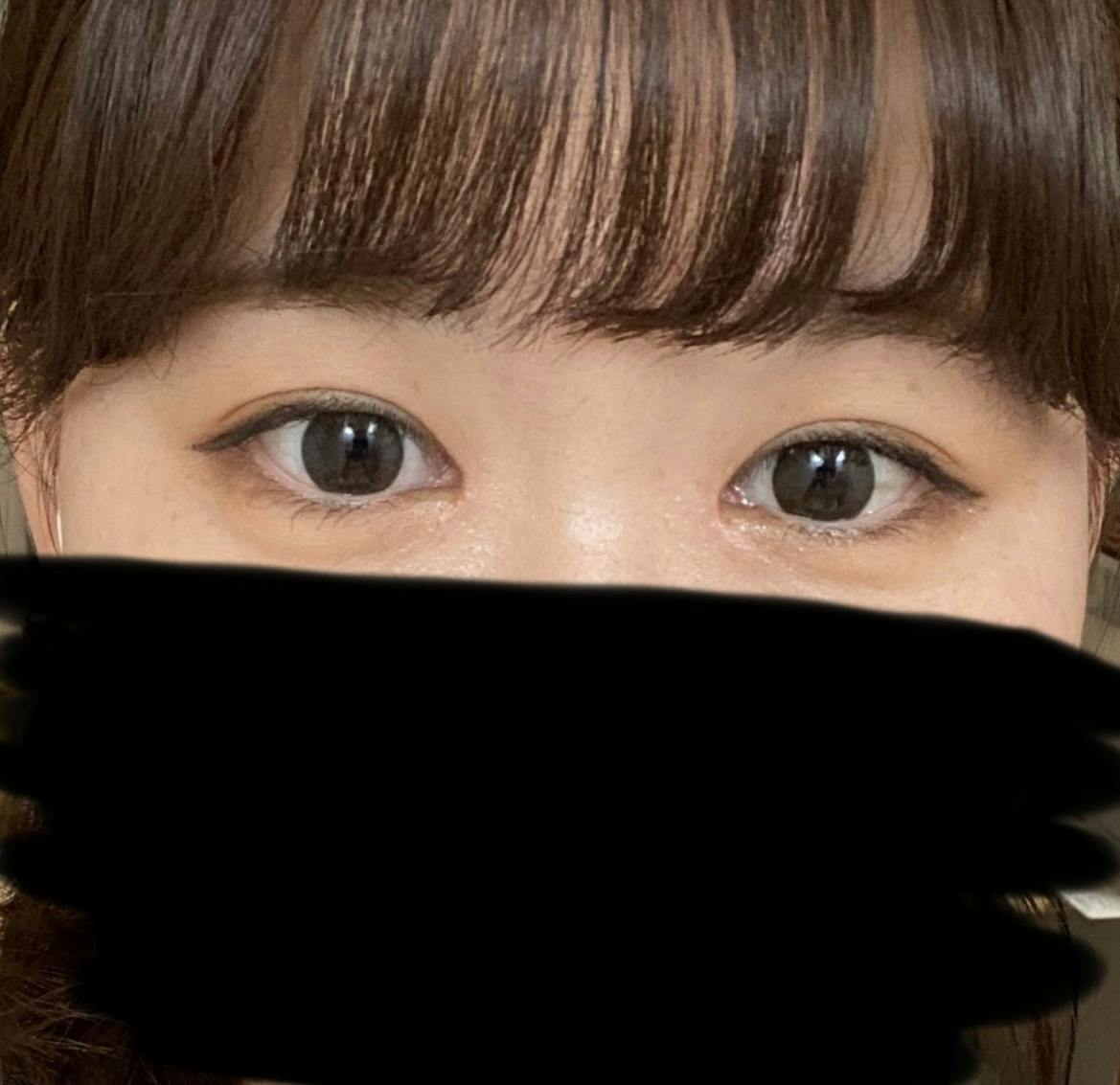 水の森美容クリニック 名古屋院で二重切開を受けたみかさんの写真
