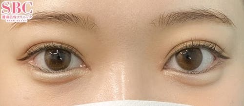 【女性・目元】クイックコスメティーク・ダブルNeo、目頭切開プレミアム、目尻切開法_after