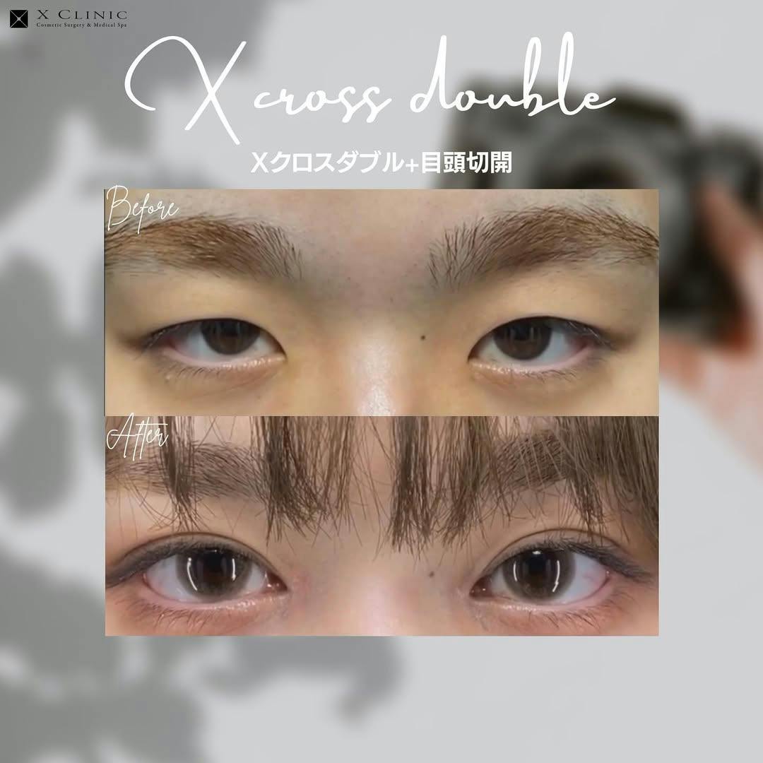 【女性・目元】×クロスダブル+目頭切開_before_aftar