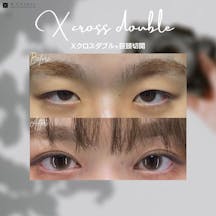 【女性・目元】×クロスダブル+目頭切開_before_aftar