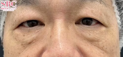 【たるみ】アイバックリムーブ法・ナチュラル脂肪注射コンデンスリッチ_before