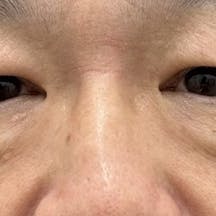 【たるみ】アイバックリムーブ法・ナチュラル脂肪注射コンデンスリッチ_before