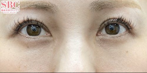 【女性・目元】目の下の切らないクマ・たるみ（ふくらみ）取り、ナチュラル脂肪注射コンデンスリッチ、ナチュラル脂肪注射ナノリッチ_after