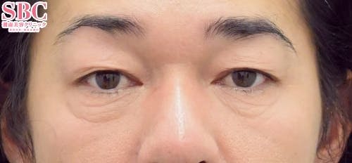 【目元】アイバックリムーブ法、ナチュラル脂肪注射コンデンスリッチ、ナチュラル脂肪注射ナノリッチ_before