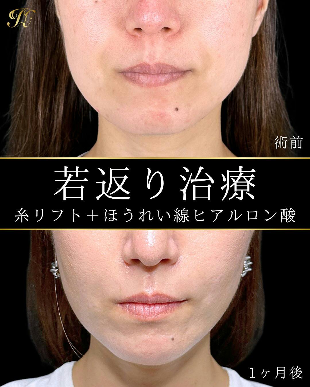 【女性・顔・ほうれい線・顎】糸リフト・ヒアルロン酸_before_aftar