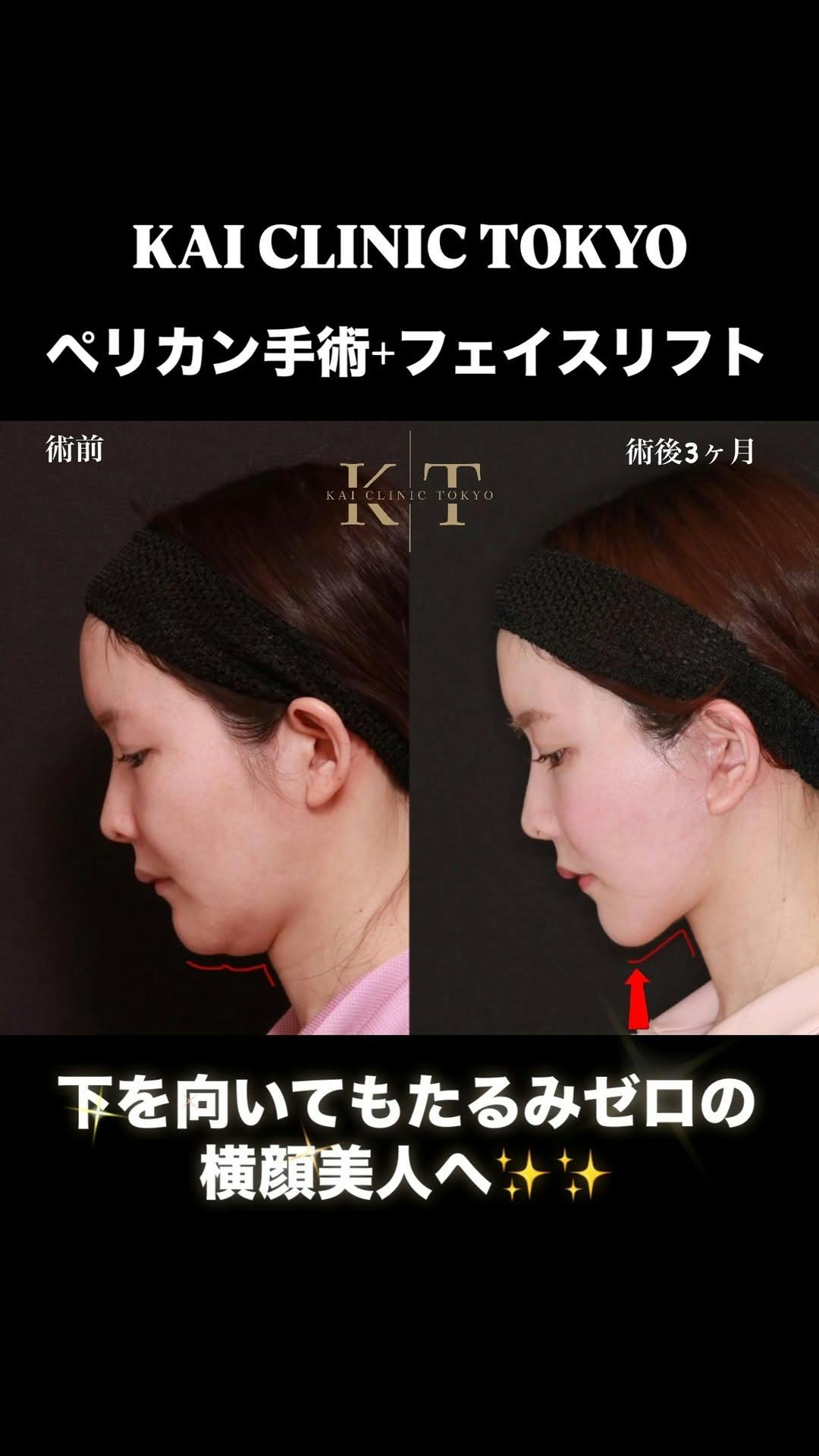 【女性・顎下】ペリカン手術・フェイスリフト_before_aftar