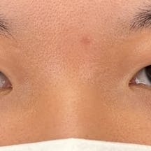 【19歳女性・目元】線留めクロス二重術 自然癒着セット(上眼瞼脱脂)_before