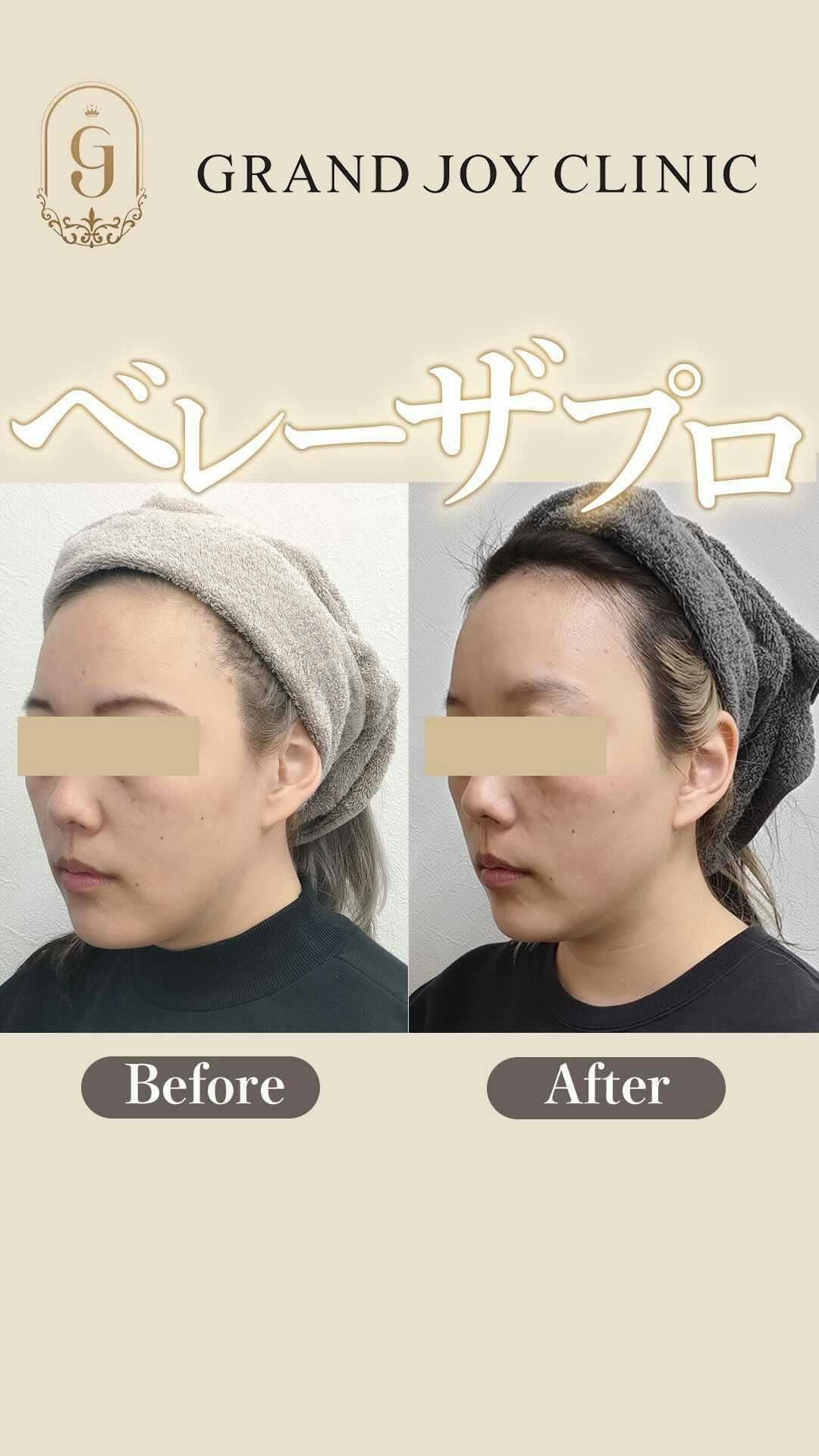 【女性・肌】ベレーザプロ_before_aftar