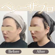 【女性・肌】ベレーザプロ_before_aftar
