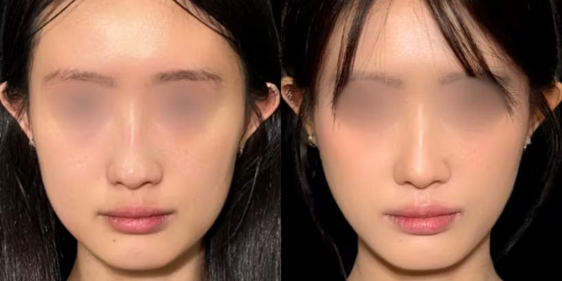 吸引でもダウンタイム最小。“切らない”でかなえる小顔術の画像