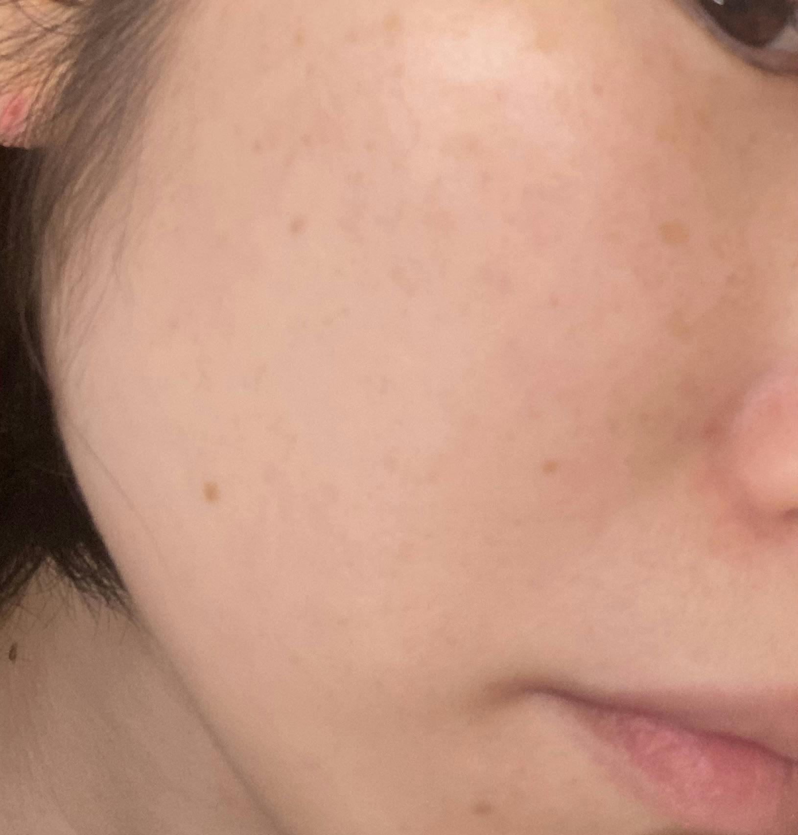 湘南美容皮フ科 新宿東口院でフォトダブルを受けたあっこさんの写真