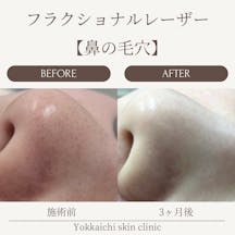 【鼻の毛穴】フラクショナルレーザー_before_aftar