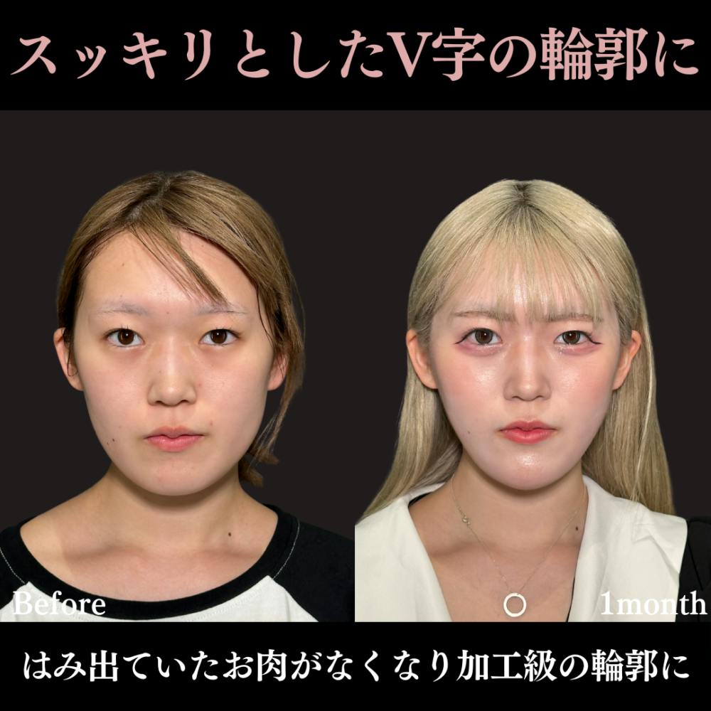 【20代女性・顔】脂肪吸引（頬・顎下）+ 糸リフト + あご先リフト + エラボトックス_before_aftar