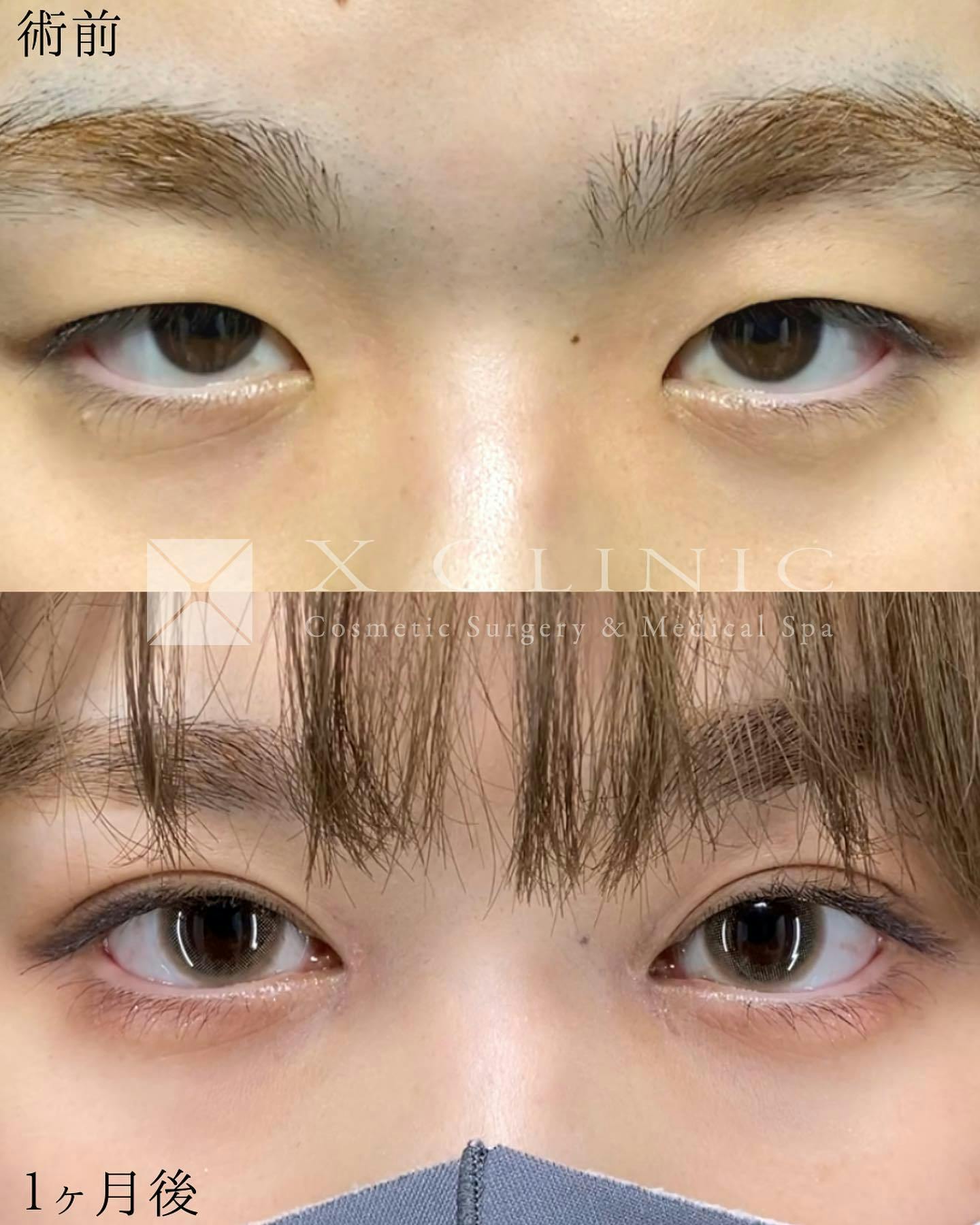 【女性・目元】エックスクロスダブル 目頭切開_before_aftar