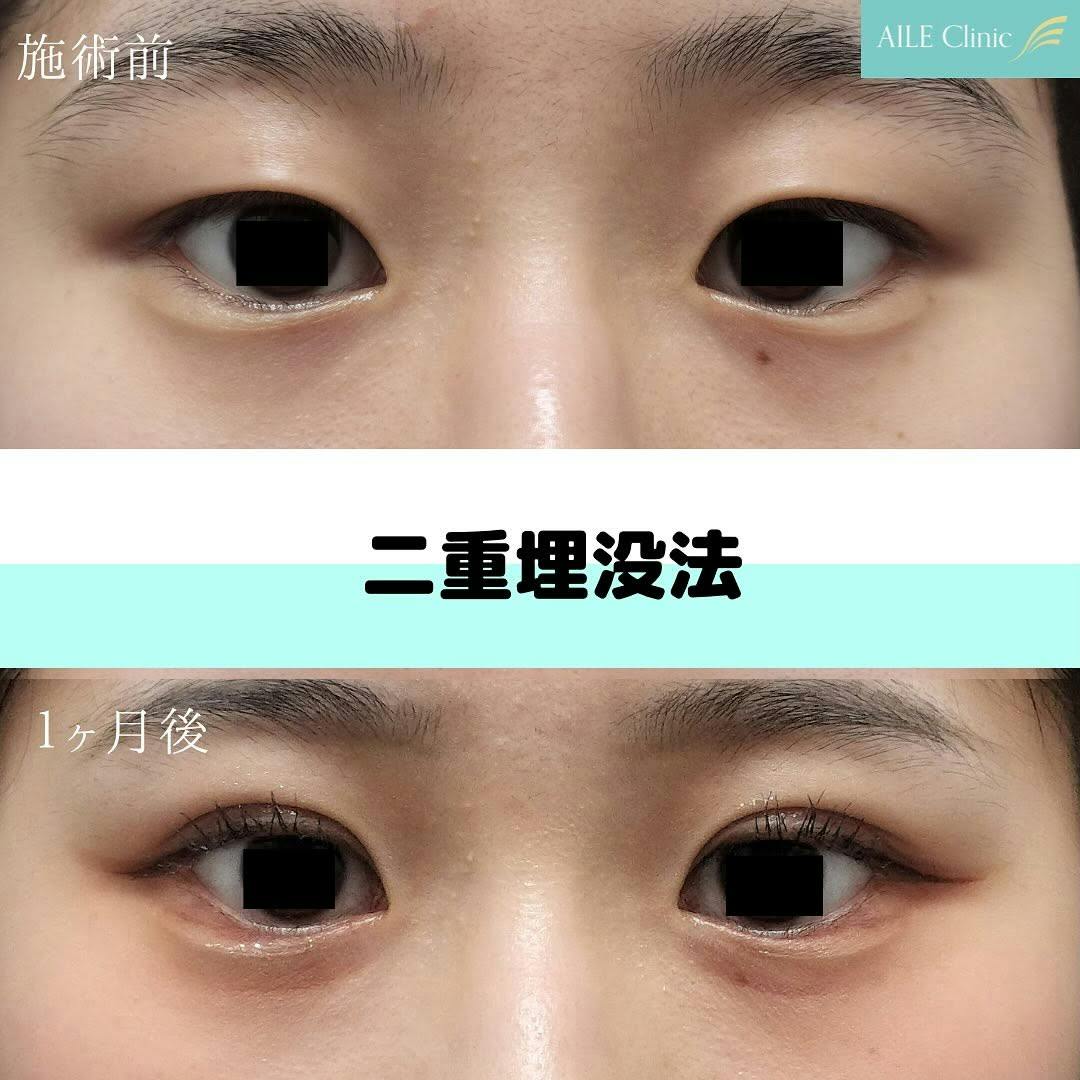 【女性・目元】二重埋没法_before_aftar