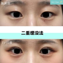 【女性・目元】二重埋没法_before_aftar
