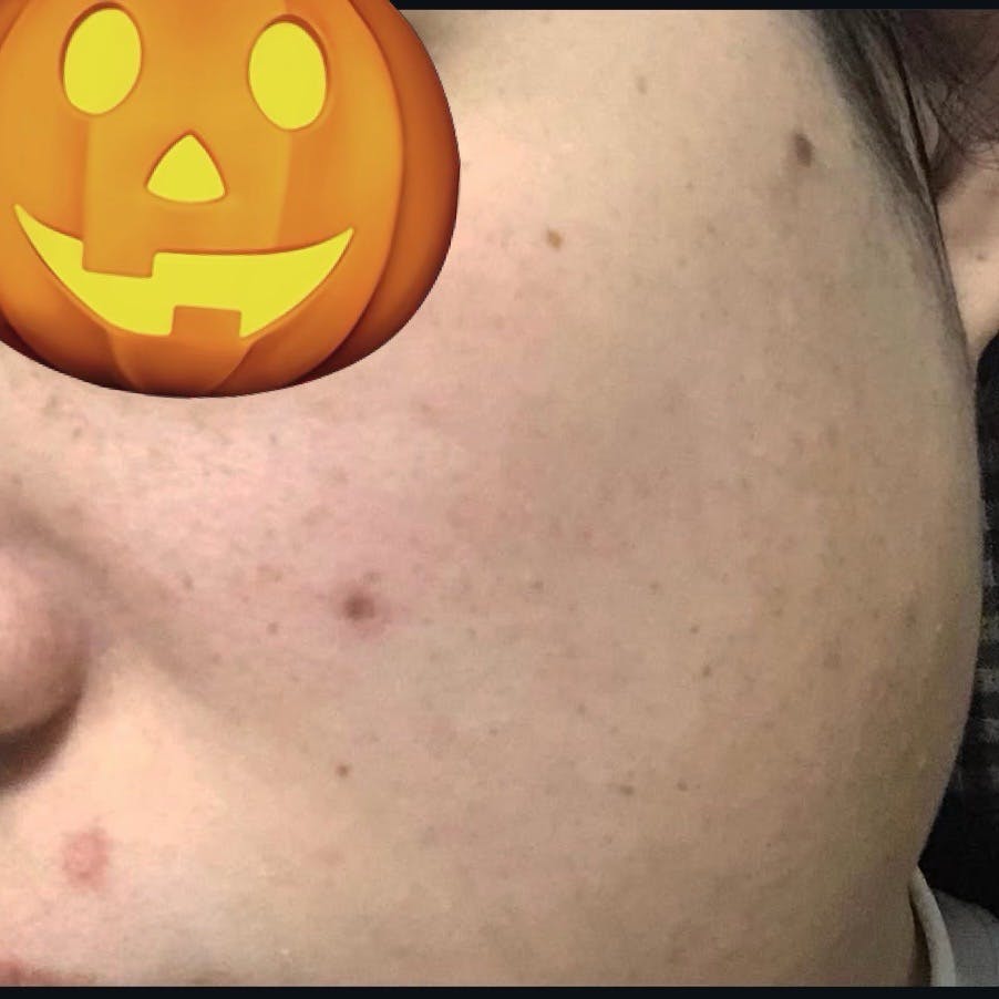 TCB東京中央美容外科 郡山院でほくろ・いぼ除去を受けたかぼさんの写真