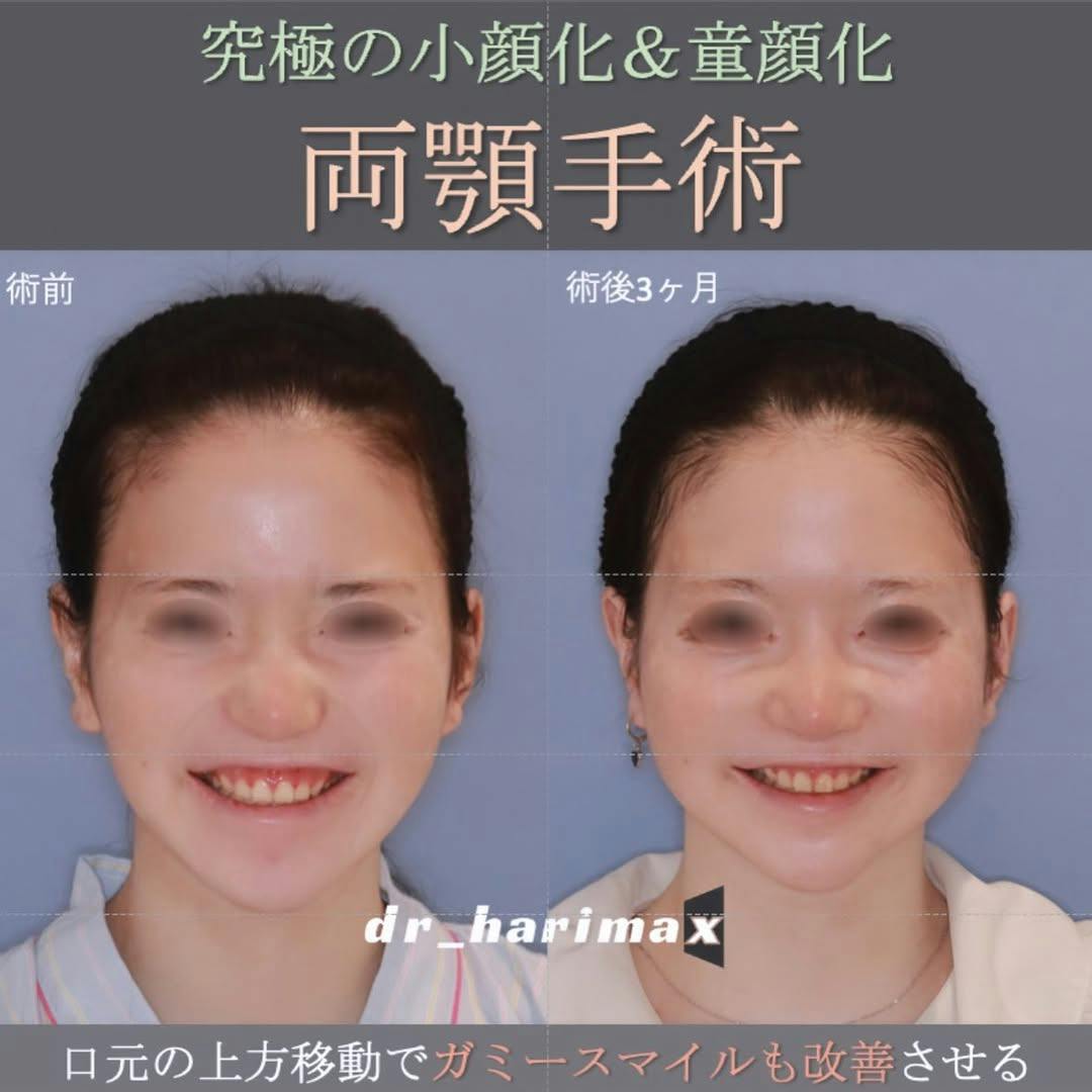 【女性・顎】上下顎骨切り術_before_aftar