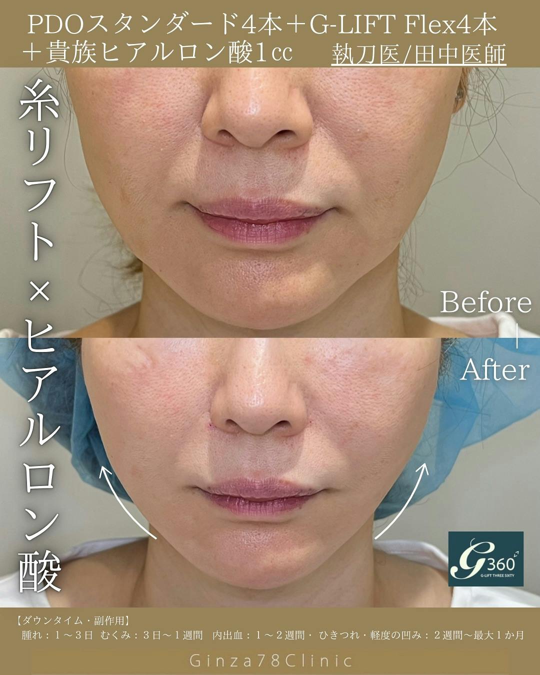 【女性・小顔】糸リフト_before_aftar
