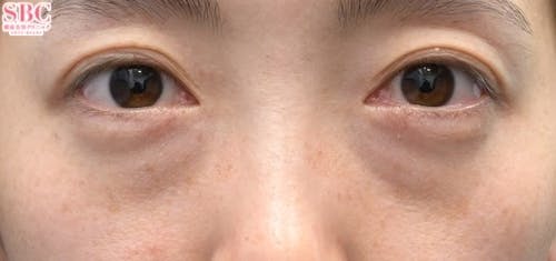【女性・目元】目の下の切らないクマ・たるみ（ふくらみ）取り、ナチュラル脂肪注射コンデンスリッチ、ナチュラル脂肪注射ナノリッチ_before