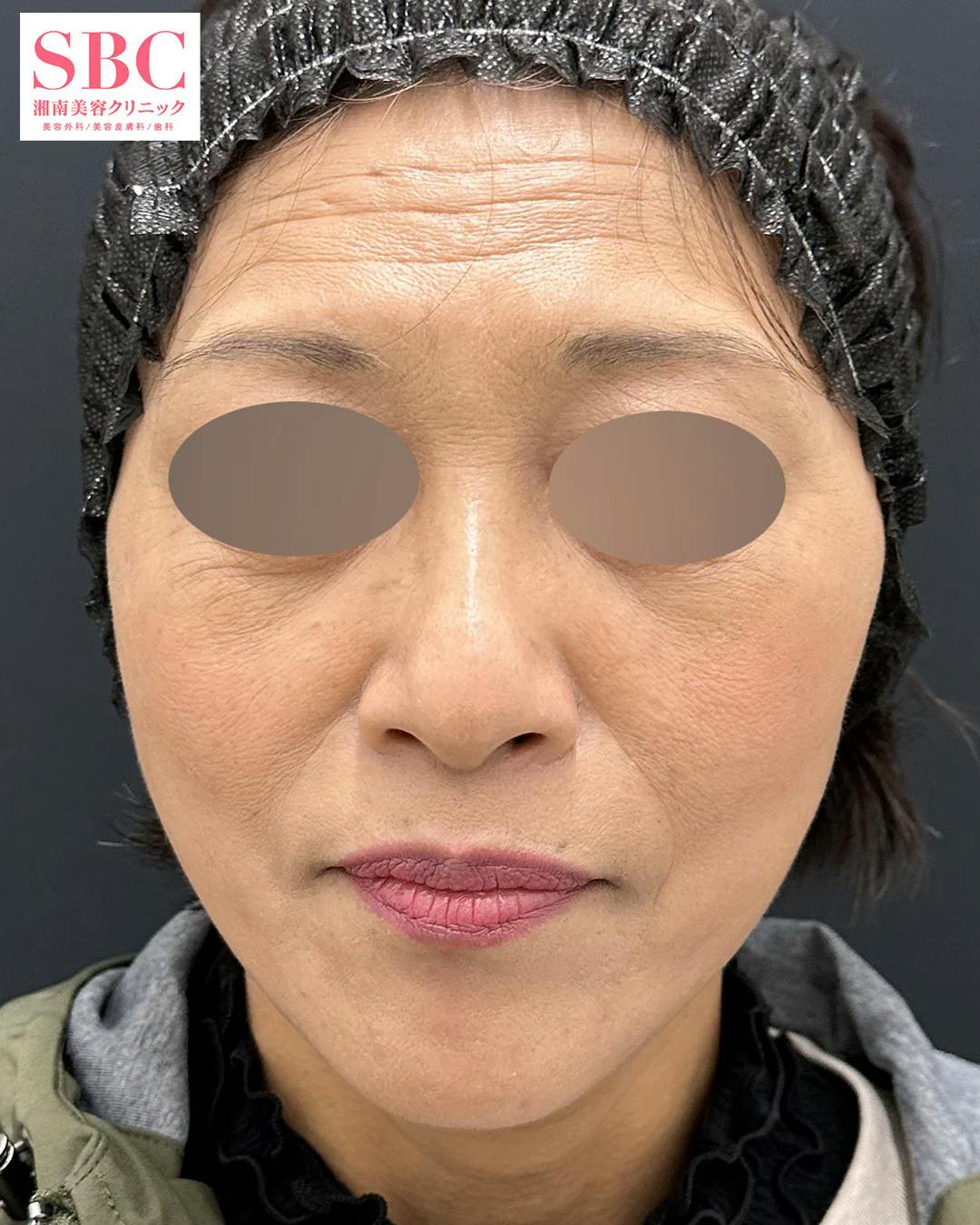 【女性・たるみ】スマスフェイスリフト_after