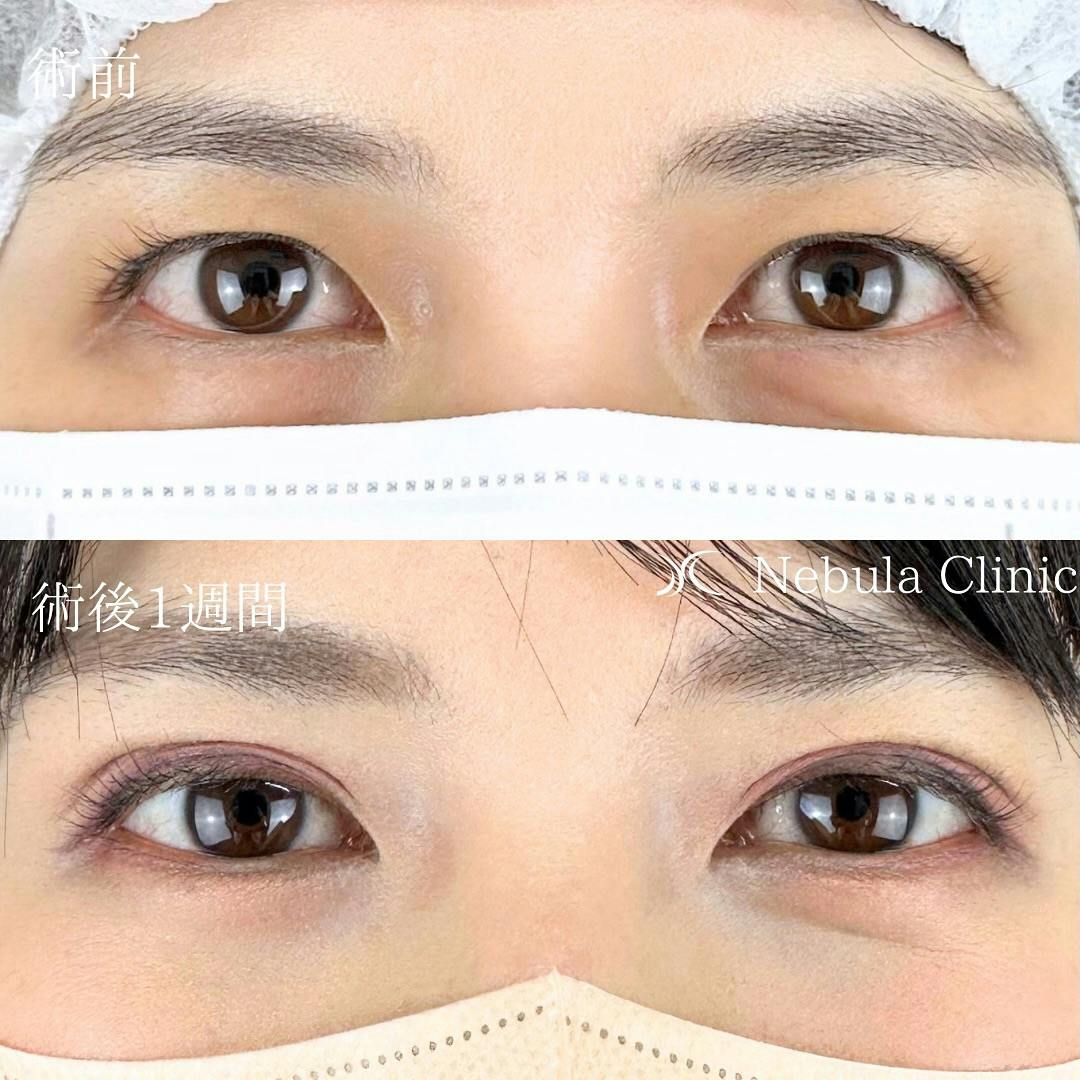 【女性・目元】二重埋没法_before_aftar