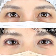 【女性・目元】二重埋没法_before_aftar