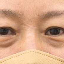 【50代女性・目元】眉下リフト(眉下切開)_before