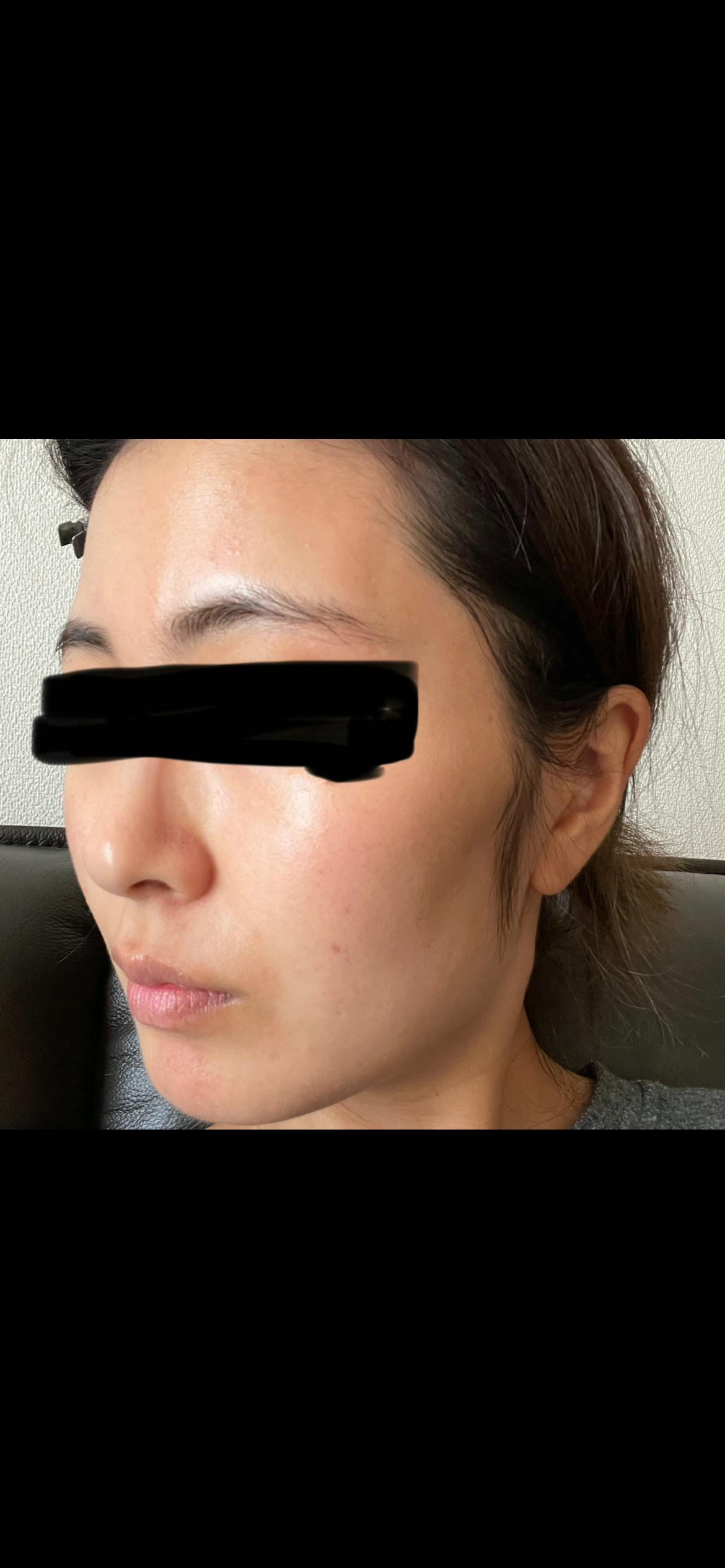 湘南美容クリニック 横浜院でピコトーニングを受けたはるさんの写真