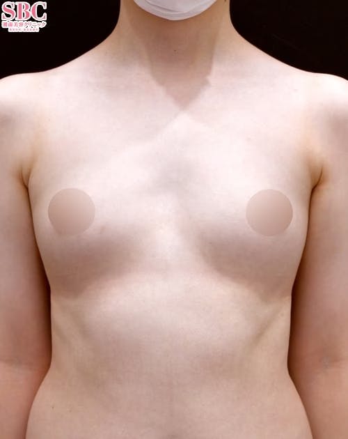 【20代女性・胸】ライポマティック併用セルーション(脂肪注入豊胸)・Aquicell（アキーセル）併用コンデンスリッチ(脂肪注入豊胸)・コールマン式_before