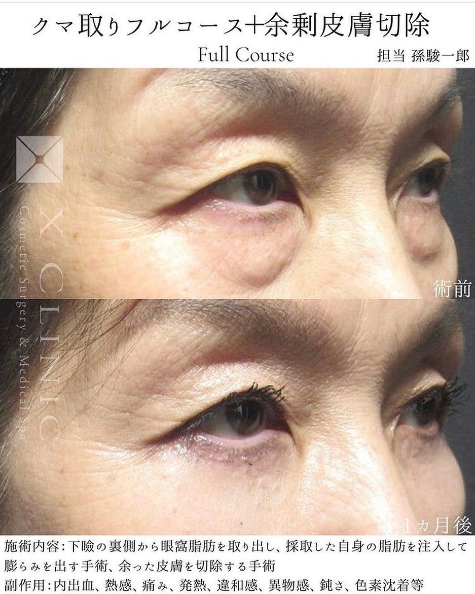 【女性・目元】クマ取りフルコース 余剰皮膚切除_before_aftar