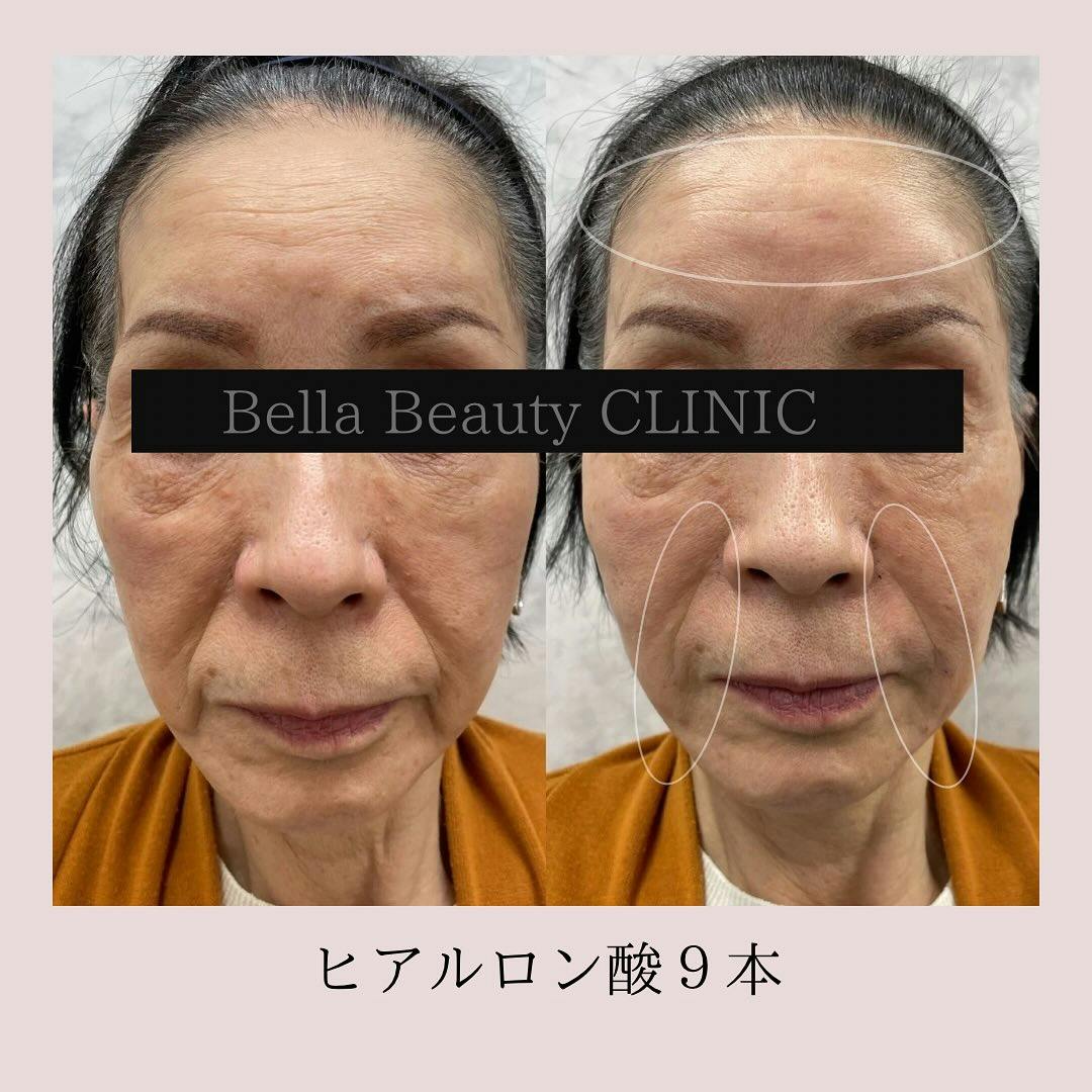 【女性・シワ】ニューラミスヒアルロン酸_before_aftar