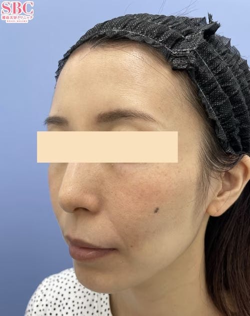 【女性・頬】ヒアルロン酸ジュビダームビスタ バイクロスシリーズ_after