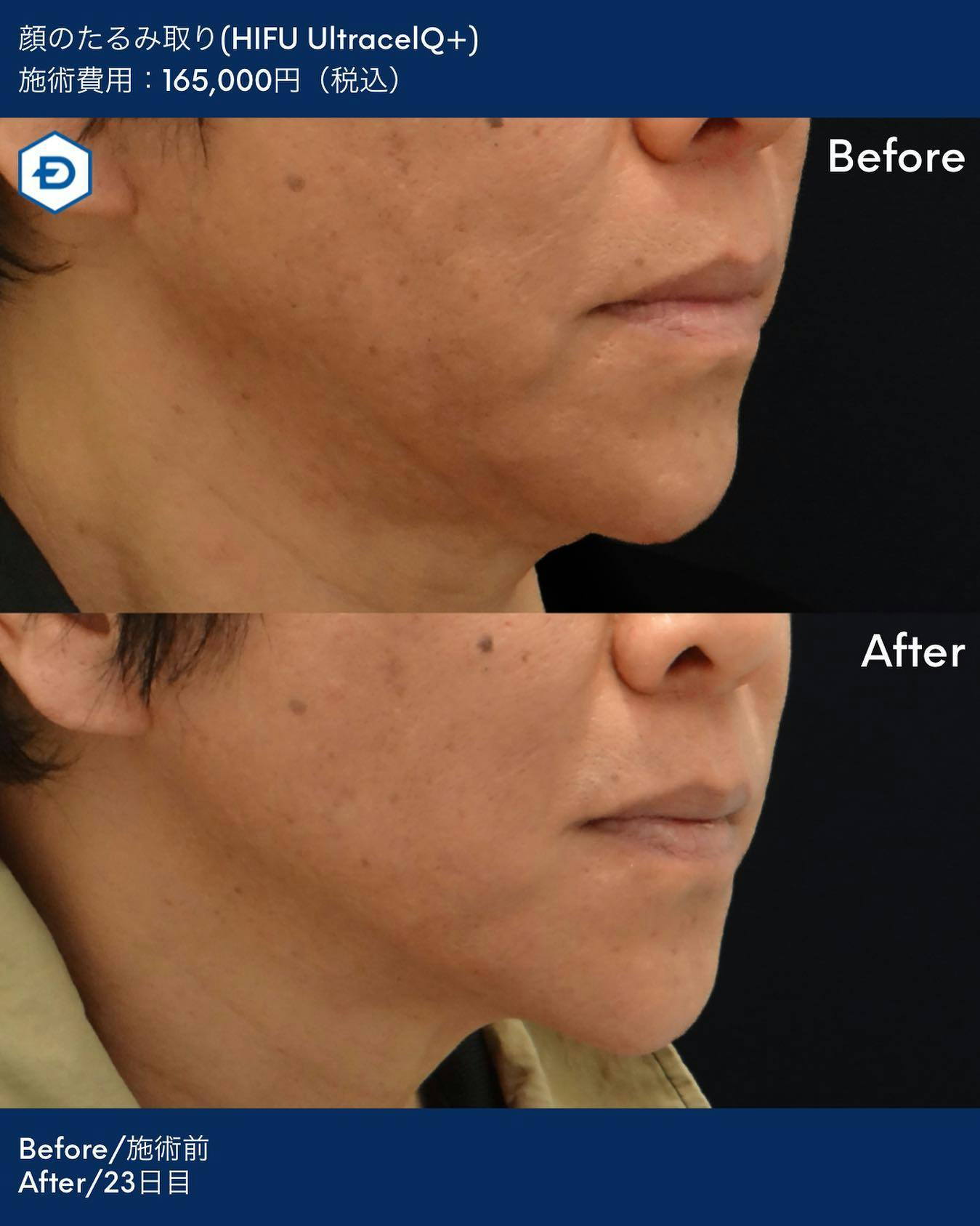 【男性・たるみ】顔のたるみ取り(HIFU UltracelQ+)_before_aftar