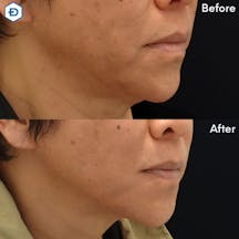 【男性・たるみ】顔のたるみ取り(HIFU UltracelQ+)_before_aftar