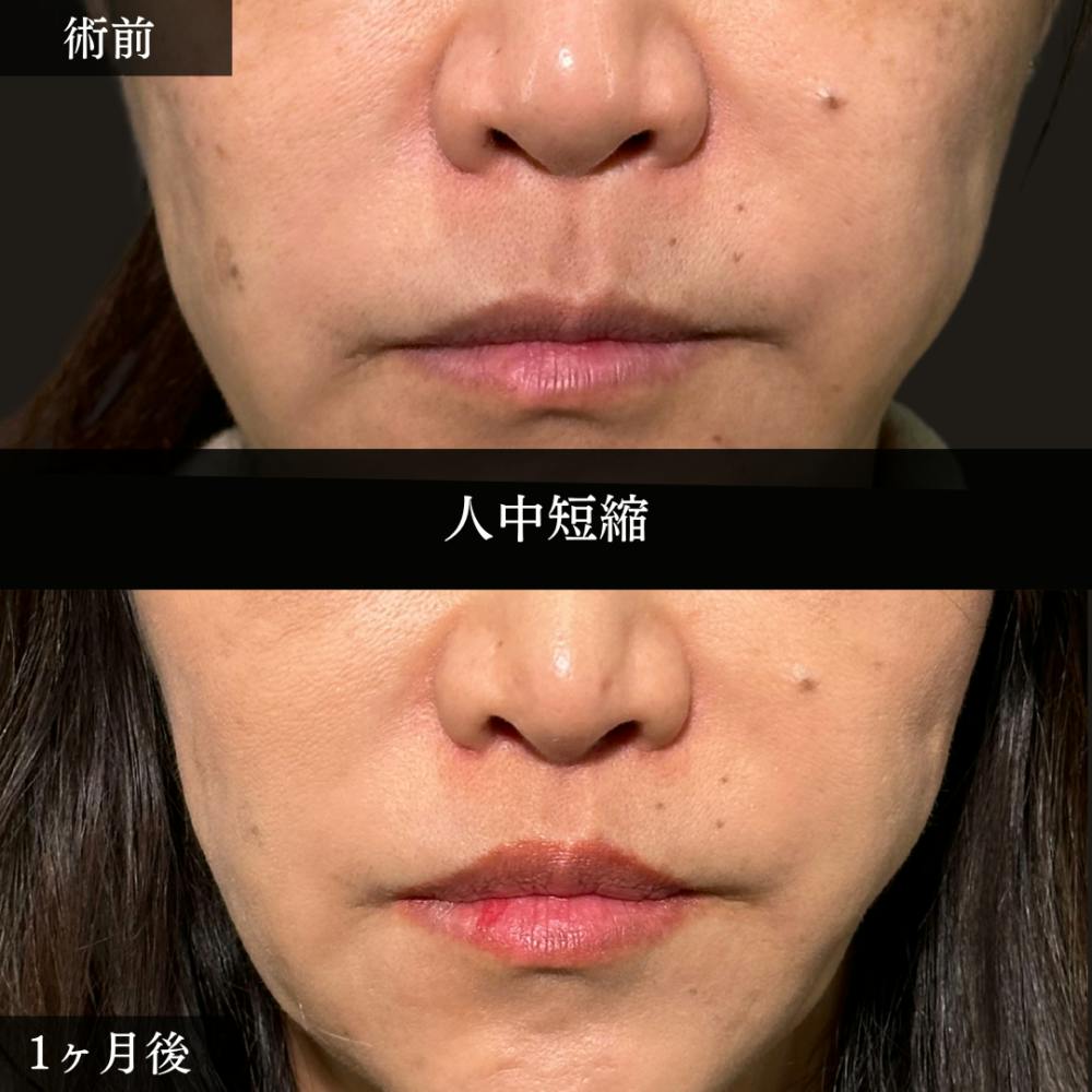【40代女性・人中】人中短縮_before_aftar