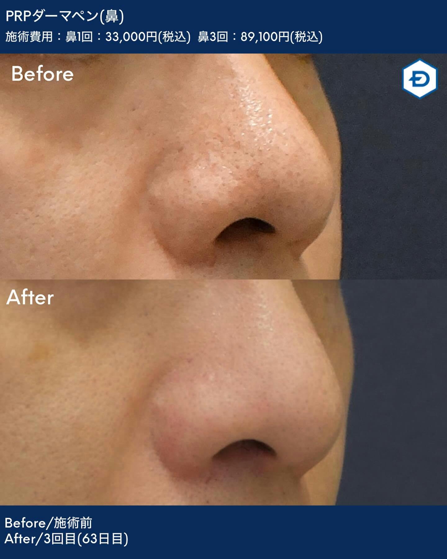 【男性・毛穴】PRPダーマペン(鼻)_before_aftar