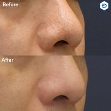 【男性・毛穴】PRPダーマペン(鼻)_before_aftar