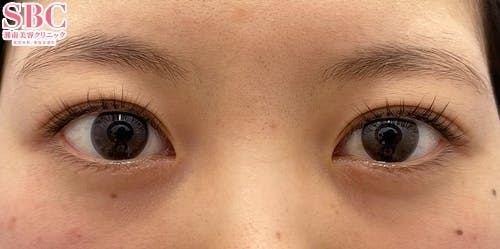 【女性・目元】二重_before
