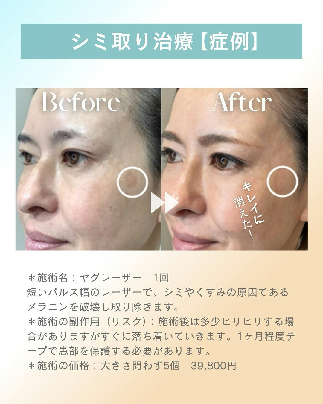 【女性・シミ】シミ取り放題_before_aftar