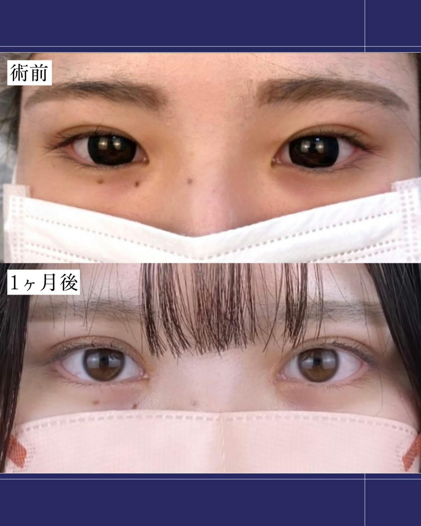 【女性・目元】二重埋没法＋目頭切開_before_aftar