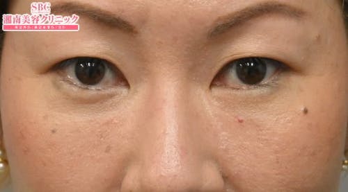 【40代女性・目元】目の下の切らないクマ・たるみ（ふくらみ）取り ナチュラル脂肪注射コンデンスリッチ ナチュラル脂肪注射ナノリッチ_after