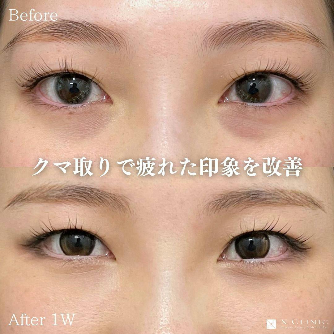 【20代女性・目元】クマ取りフルコース(クマ取り＋コンデンス＋ナノファット)_before_aftar