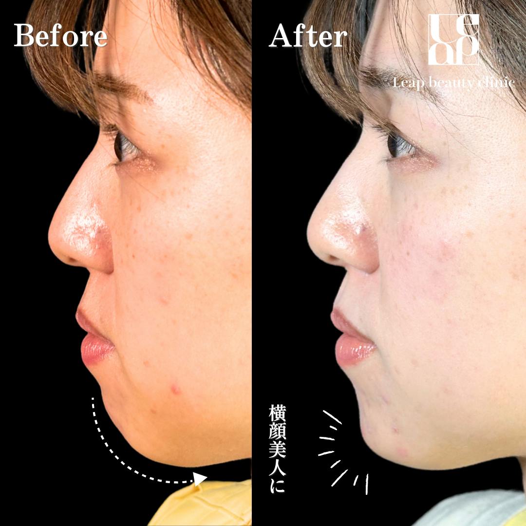 【20代女性・顎】あごヒアルロン酸・ボトックス_before_aftar