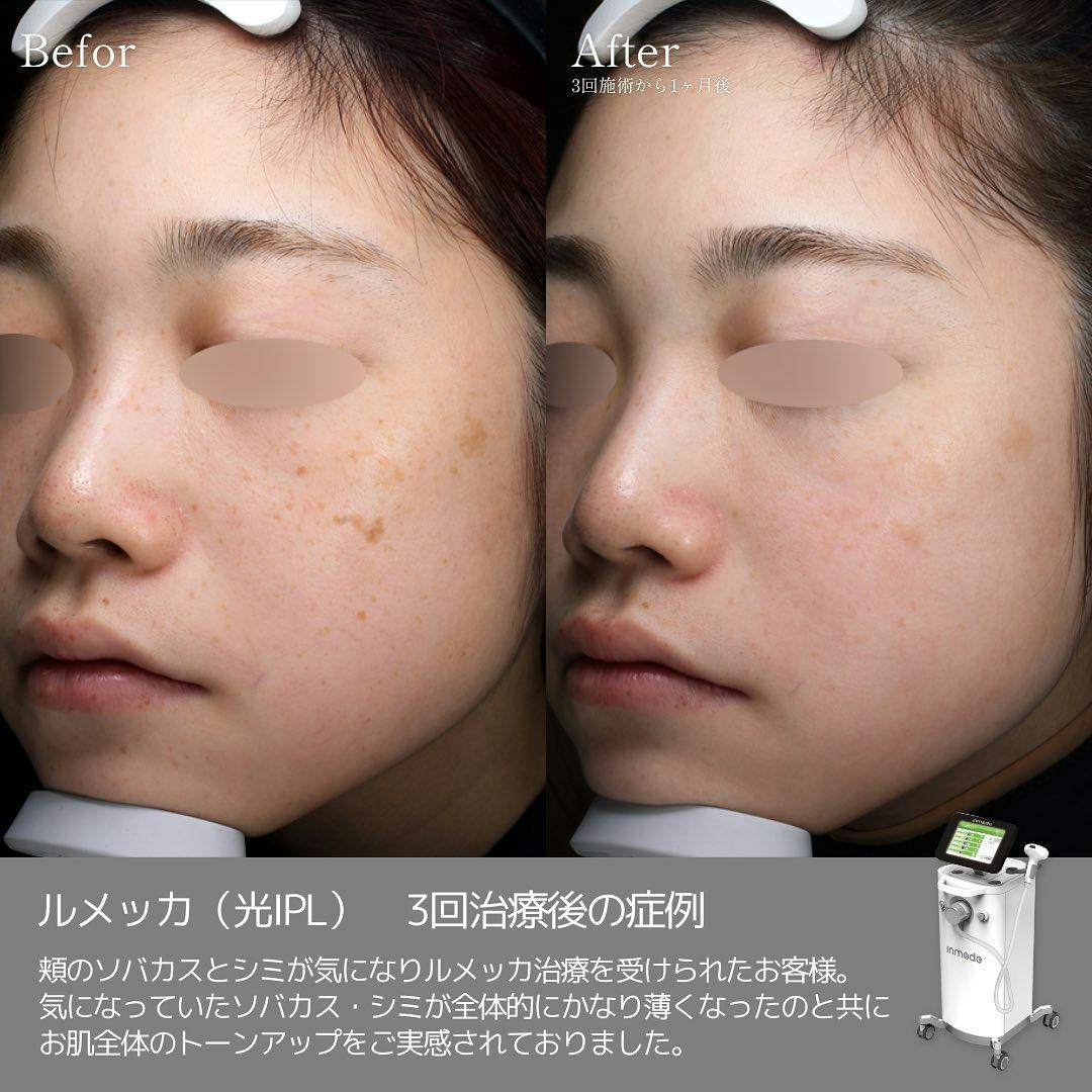 【女性・シミ】ルメッカ_before_aftar