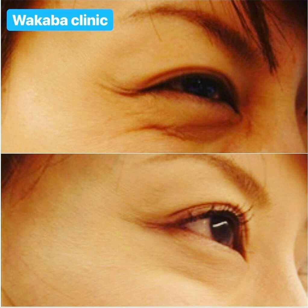 【女性・シワ】ボトックス_before_aftar