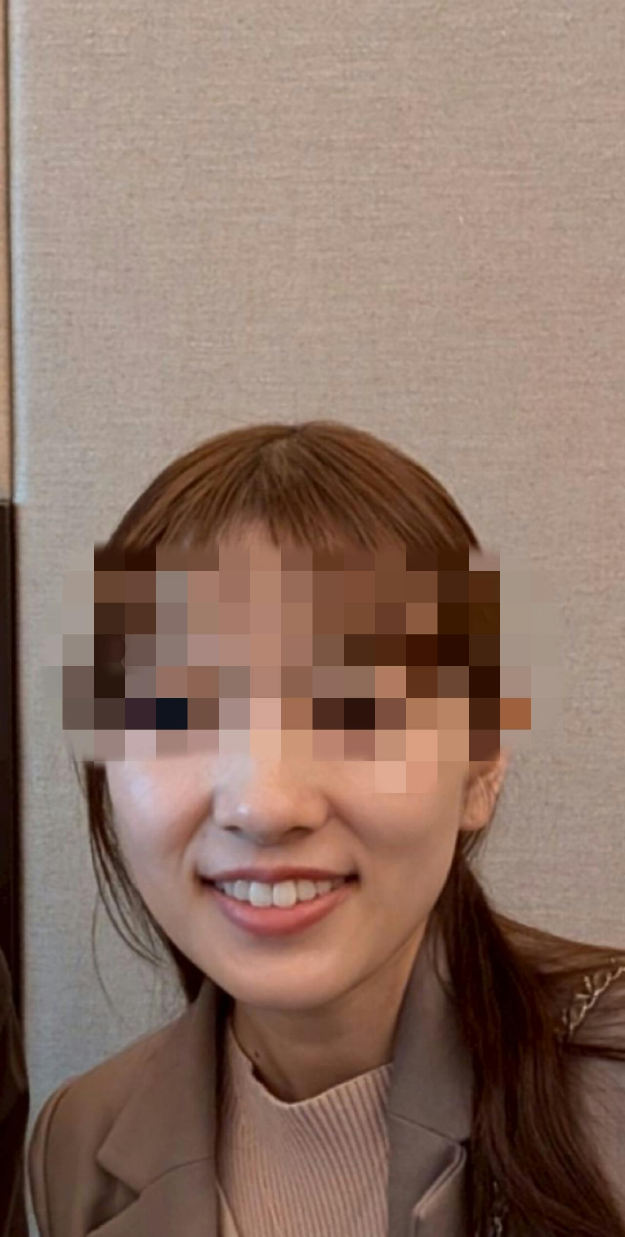 ココンベルクリニック(Cocon-Belle Clinic)でボトックス注射・エラボトックス注射(小顔)・韓国製ボトックス・ボツリヌストキシン・アラガン製ボトックス・コアトックス(CORETOX)・ボトックスビスタを受けたなすさんの写真