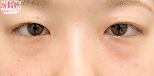 【女性・目元】目の下の切らないクマ・たるみ（ふくらみ）取り、ナチュラル脂肪注射ナノリッチ、ナチュラル脂肪注射コンデンスリッチ_before